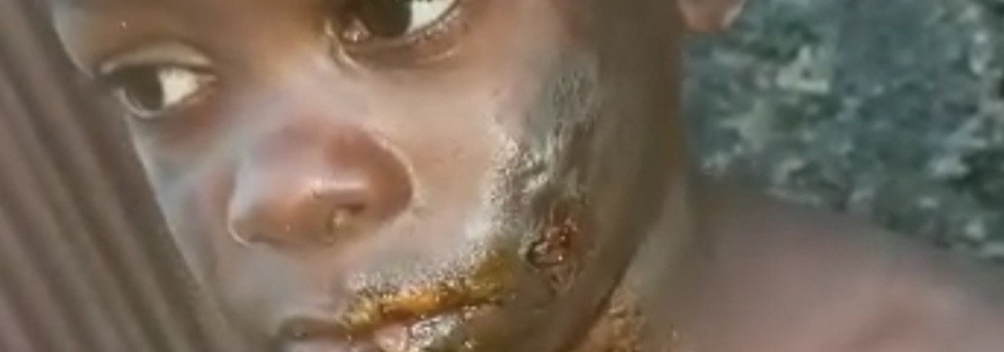 Boy Suffers Serious Burns After Physically Abused By His Aunt In Imo (Photos)